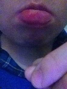 吃瓜吃的嘴唇肿了